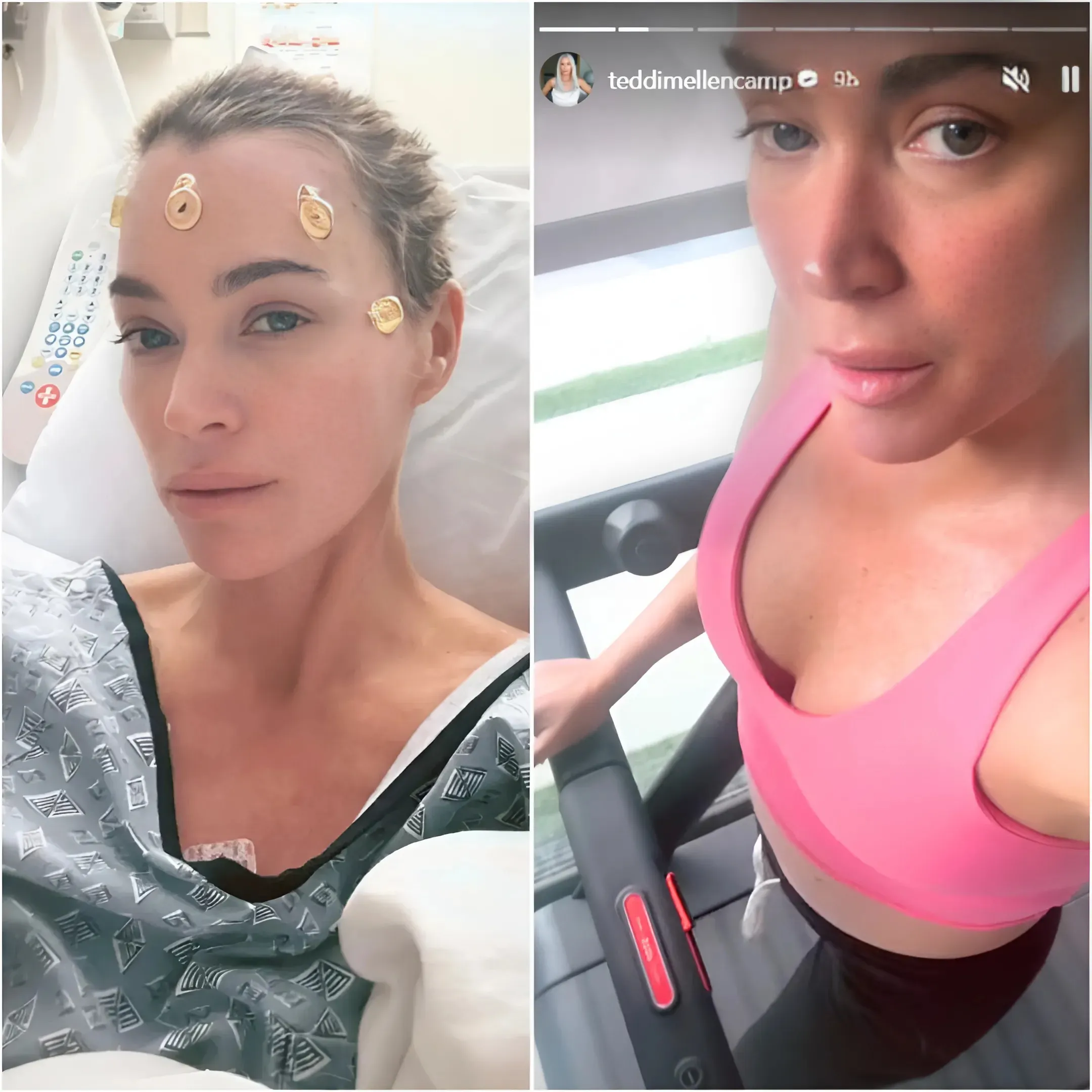 Teddi Mellencamp celebrates release from hospital after brain tumor surgery with workout, cold plunge and more: ‘F–k off tears’