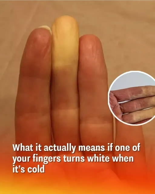 What it actually means if one of your fingers turns white when it’s cold