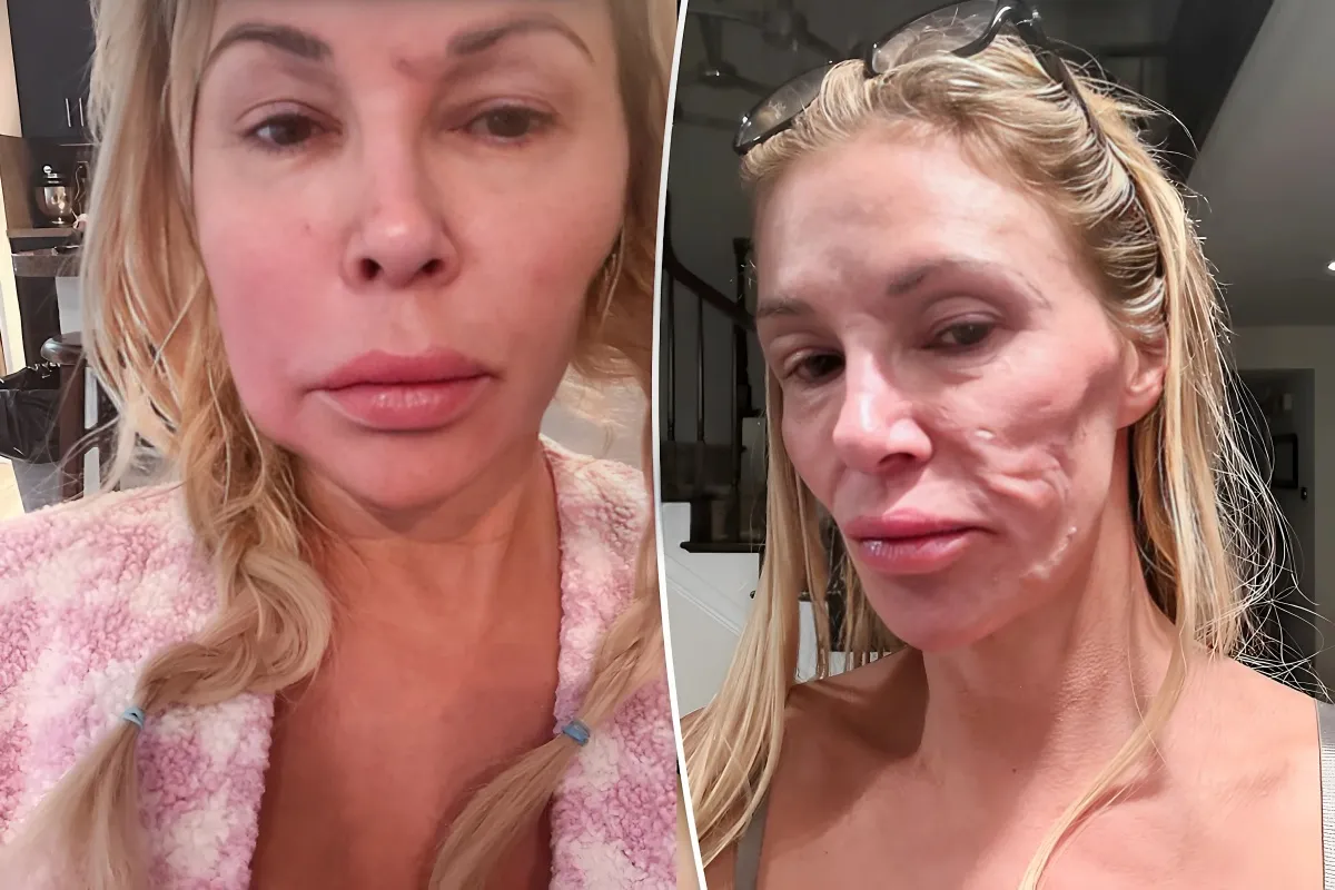 Brandi Glanville Reveals Disturbing Effects of Unexplained Facial Lumps: 'Acidic' Drainage Eating Away at Teeth - lulu