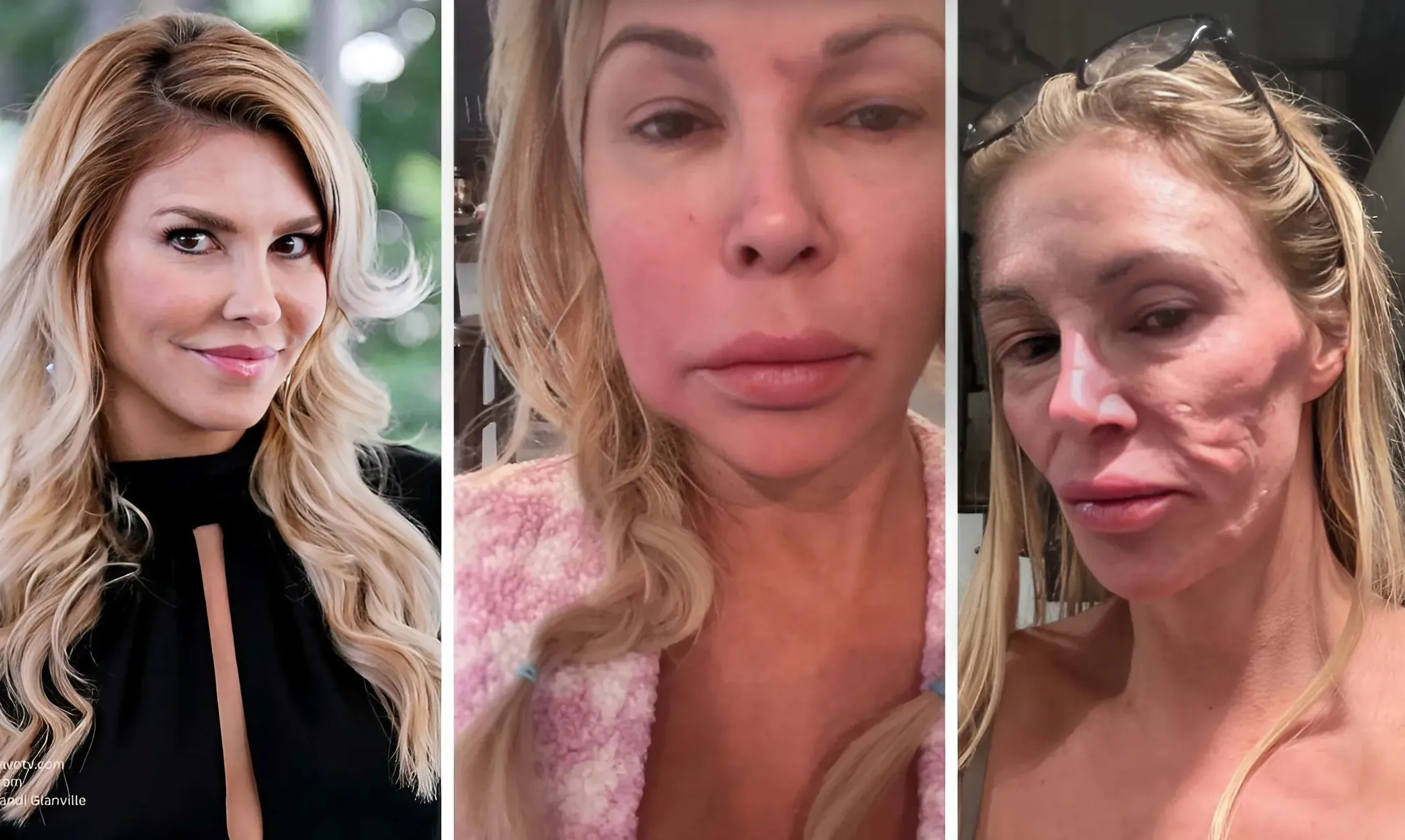 Brandi Glanville Detailed Foul Tasting Drainage From Her Face That’s Eating Away At Her Teeth-quang