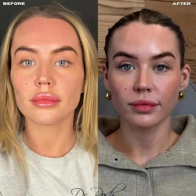 Love Island star Samantha Kenny wipes away tears after having filler dissolved as she has ‘unnatural’ look ngocc Love Island star Samantha Kenny wipes away tears after having filler dissolved as she has ‘unnatural’ look ngocc