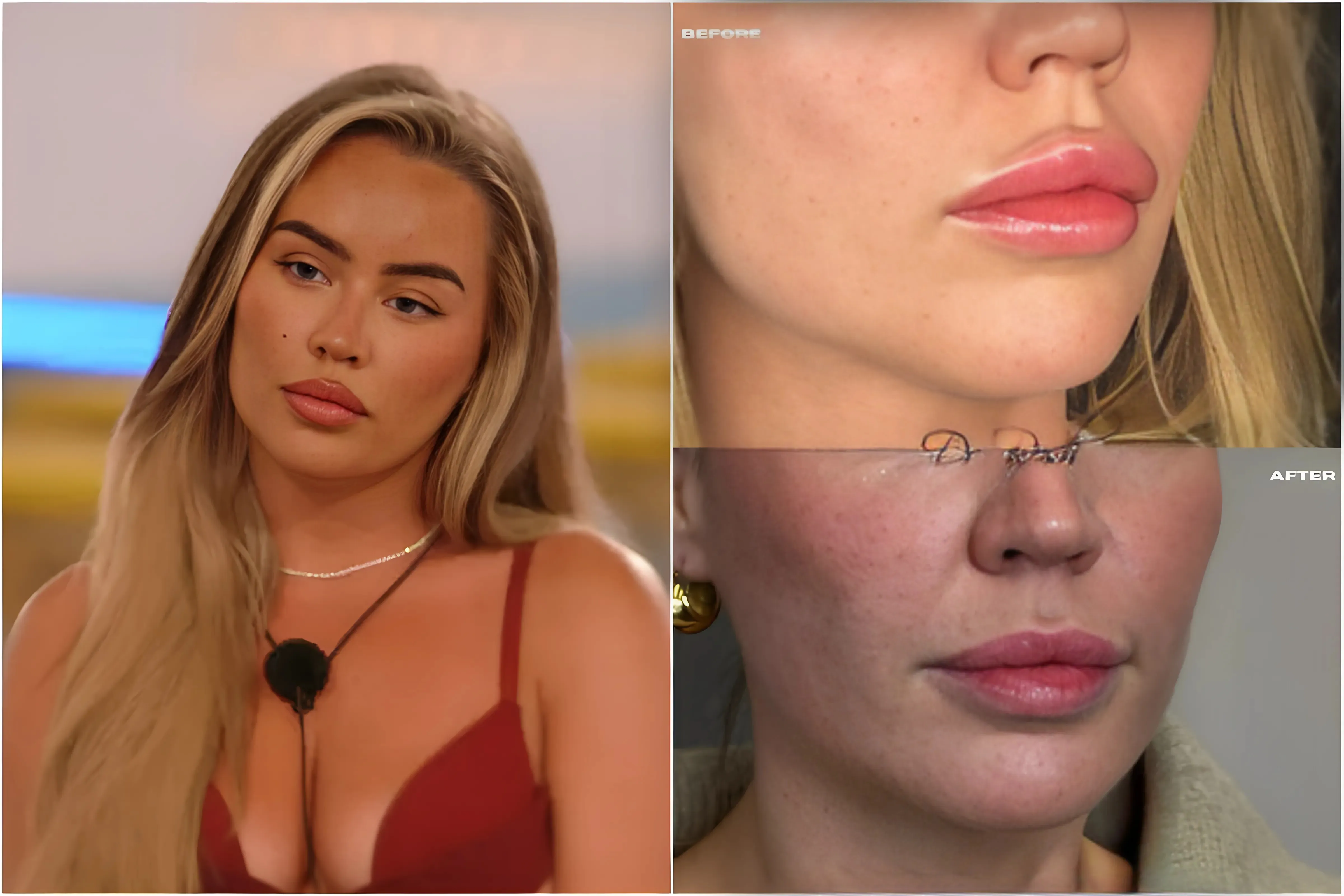 Tearful Moment: Love Island's Samantha Kenny Removes Filler, Correcting 'Unnatural' Appearance trucc