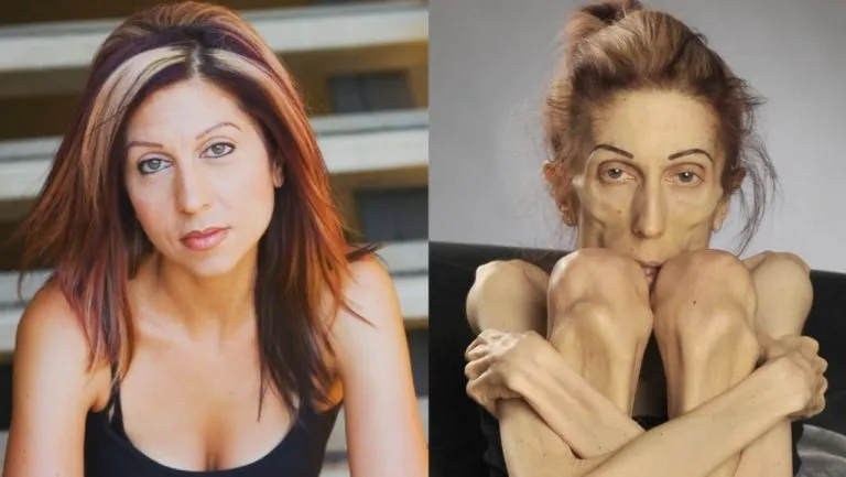 S2. The World’s Thinnest Woman’s Battle Against Anorexia Will Leave You Speechless!