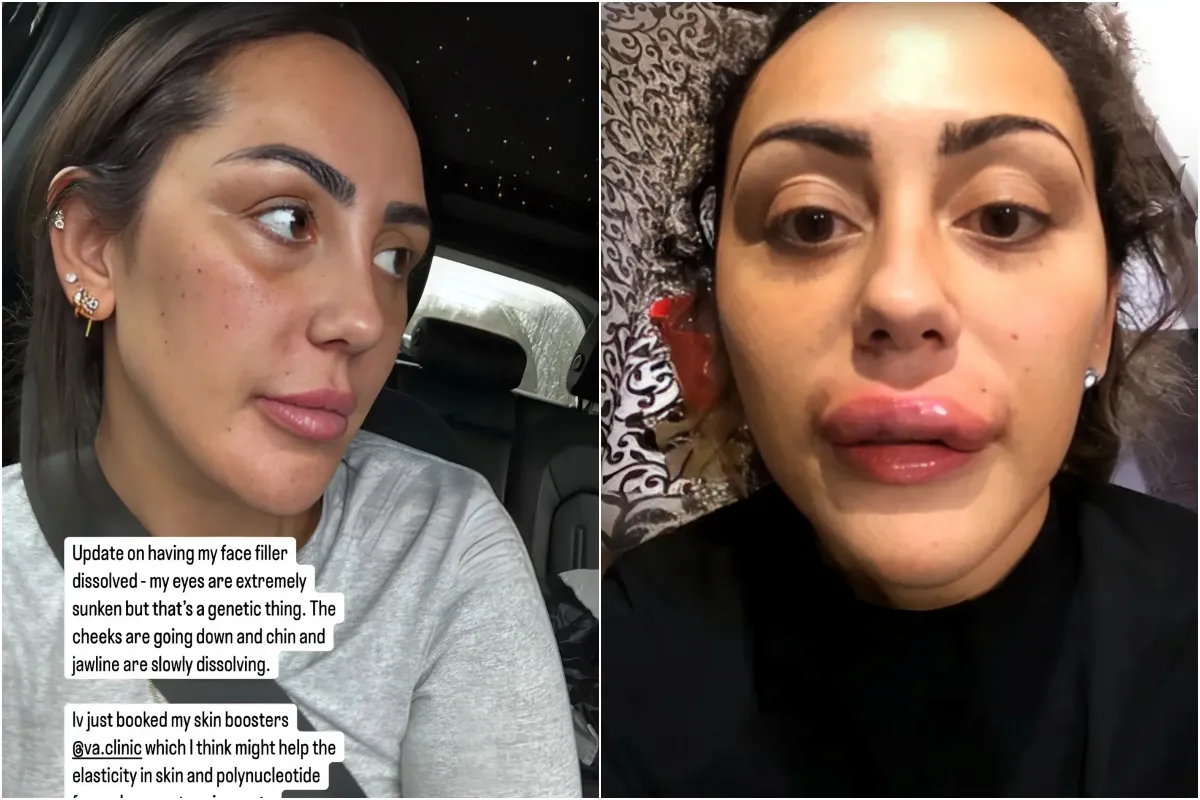 Geordie Shore’s Sophie Kasaei shows off ‘sunken face and eyes’ after having all her face filler disso ngocc