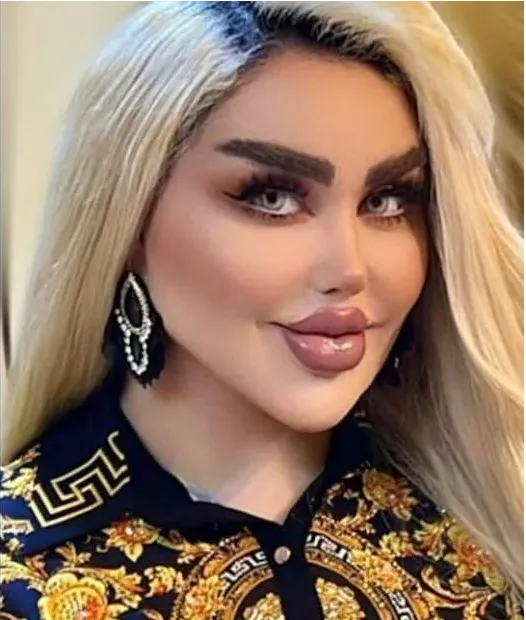Woman’s 43 operations to look like Barbie backfire Woman’s 43 operations to look like Barbie backfire