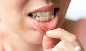 F. Be very careful if it comes out in your mouth, you are infected