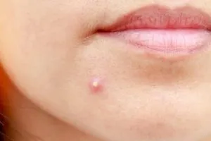 S4.  Dangerous Types of Pimples You Should Never Pop: A Guide to Healthy Skin Care