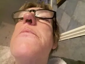 S3. I Was Afraid I Would Look Terrible On My Wedding Day After a Tiny Pimple Inside My Nostril Developed Into Skin Cancer