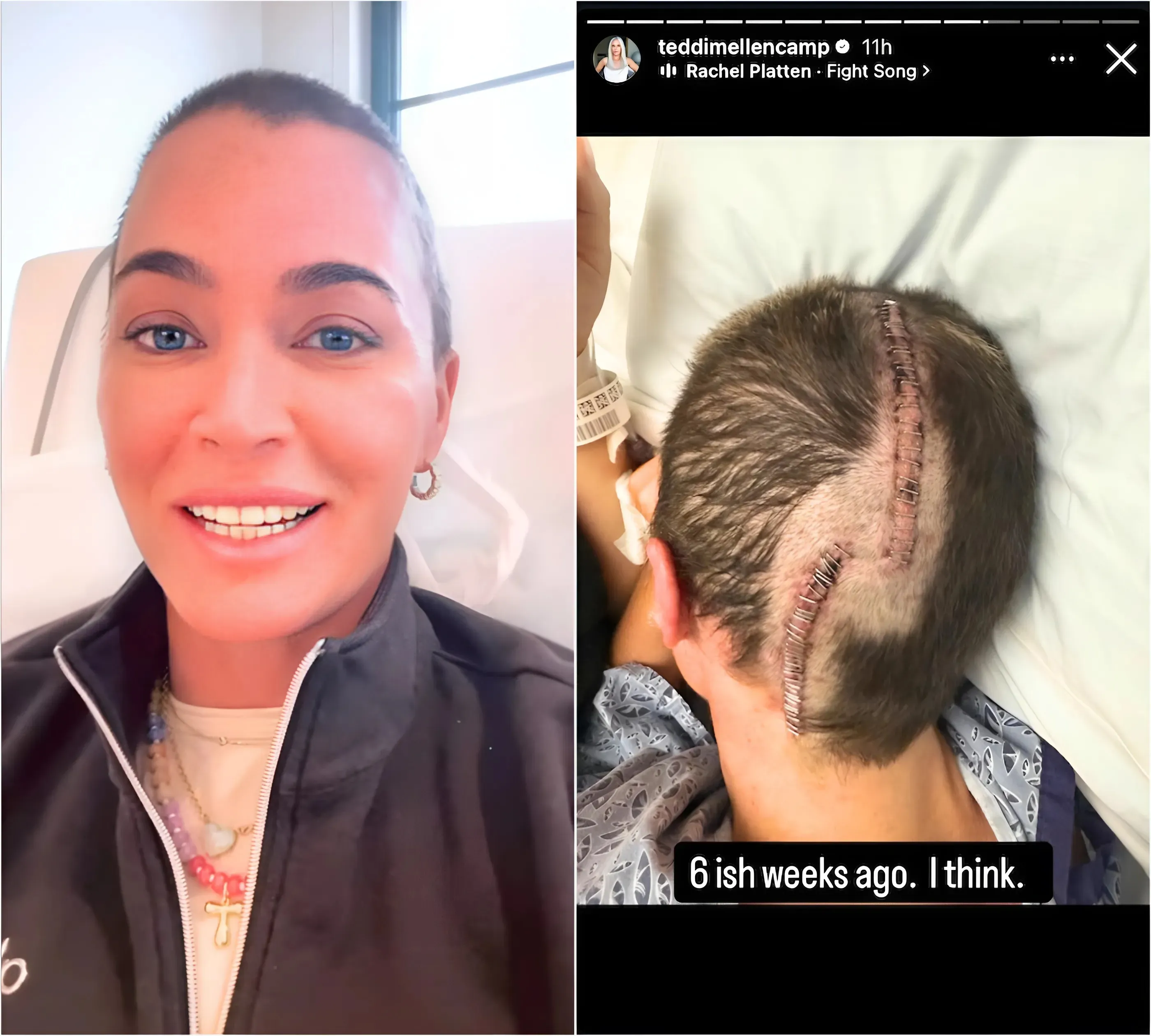 Teddi Mellencamp Shares Latest on Health Amid Brain Cancer Battle, Admits She’s Feeling “Sad and Scared” as She Shows Pic of Surgery Scars on Head