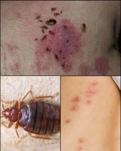 F. Doctor Explains Scabies Skin Rash: Symptoms, Photos, Treatment, and More