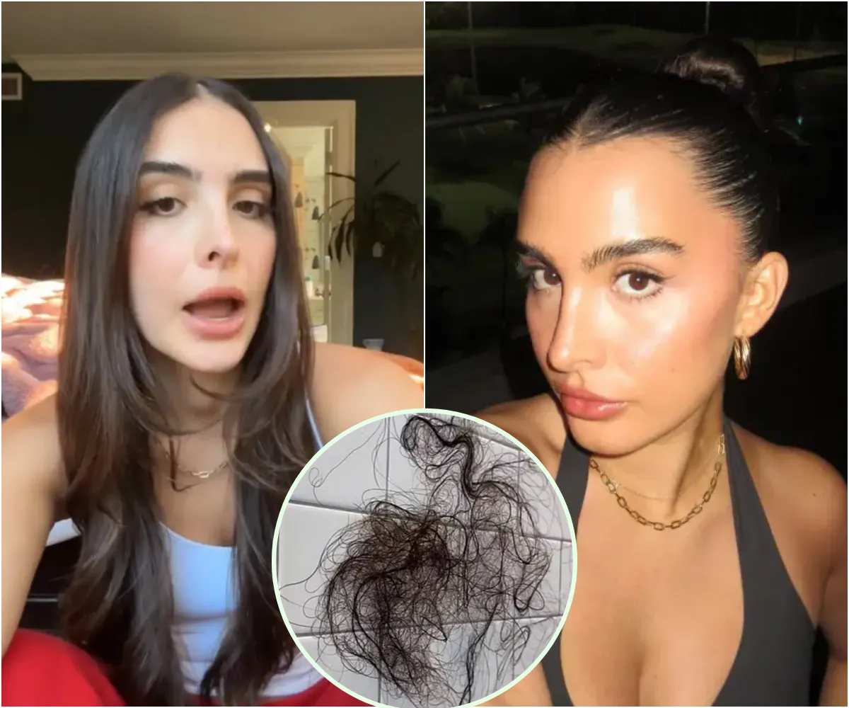Kyle Richards’ daughter Sophia, 25, reveals shock hair loss after taking weight-loss drug: ‘I’m gonna be bald’ - suong