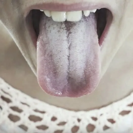 If your tongue is white, this is a clear sign that you are suffering from…