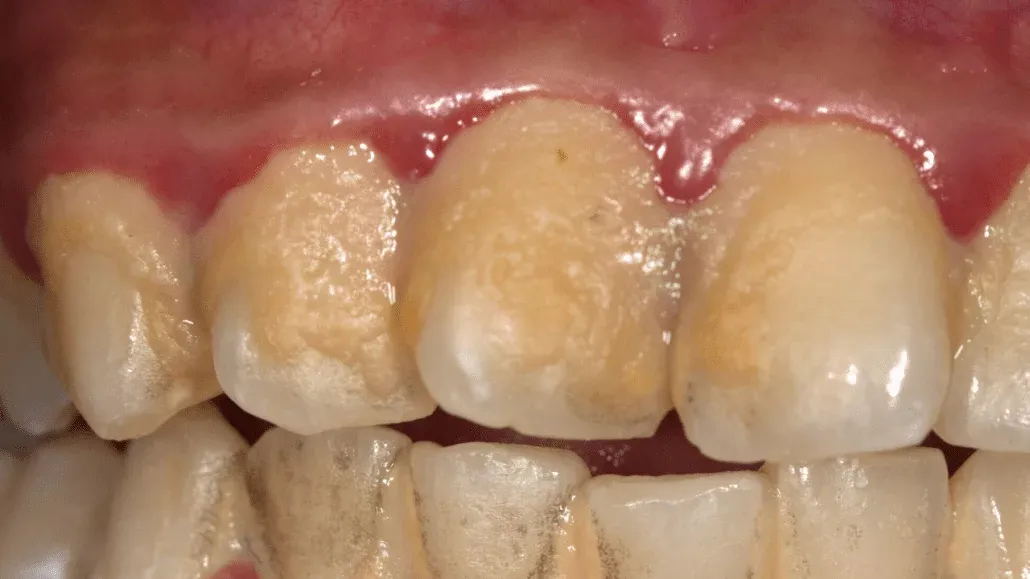 9. Be careful!! This is what your teeth will become when you eat…s2