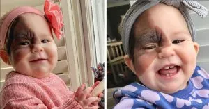 P4. Mom wants to show 13-month-old daughter with rare birthmark that she is beautiful