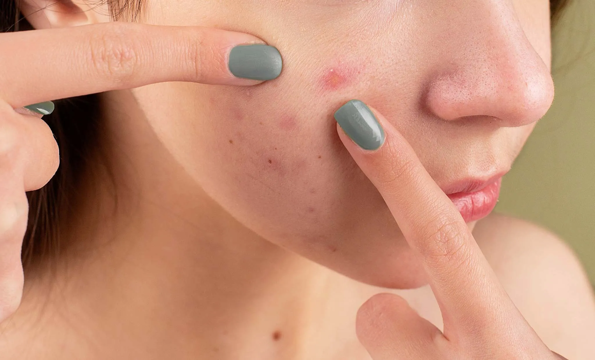 9.. Experience a Soothing and Informative Journey When You Watch ‘Relax with Squeeze Acne’
