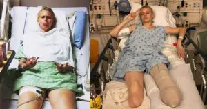 P2. Her legs are amputated after using a common household product P2. Her legs are amputated after using a common household product