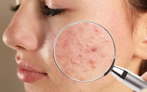 S2.  Dangerous Pimples on Your Skin You Should Never Pop: Here’s Why