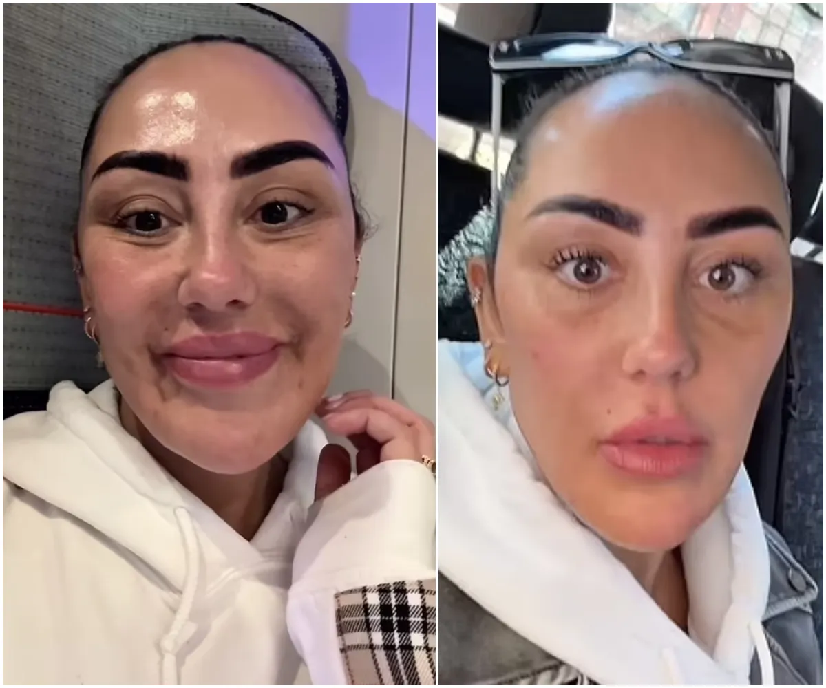 Sophie Kasaei shows off dramatic results of getting face filler dissolved at £30m Botox clinic after an allergic reaction left her with PTSD - suong