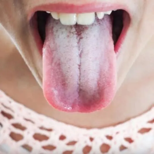 If Your Tongue Is White, this is a clear sign that you are suffering from…Read more If Your Tongue Is White, this is a clear sign that you are suffering from…Read more
