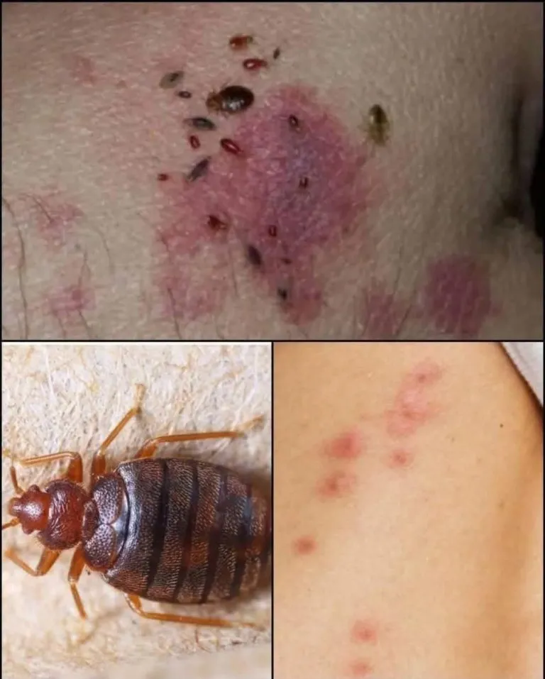 P4. Doctor Explains Scabies Skin Rash: Symptoms, Photos, Treatment, and More