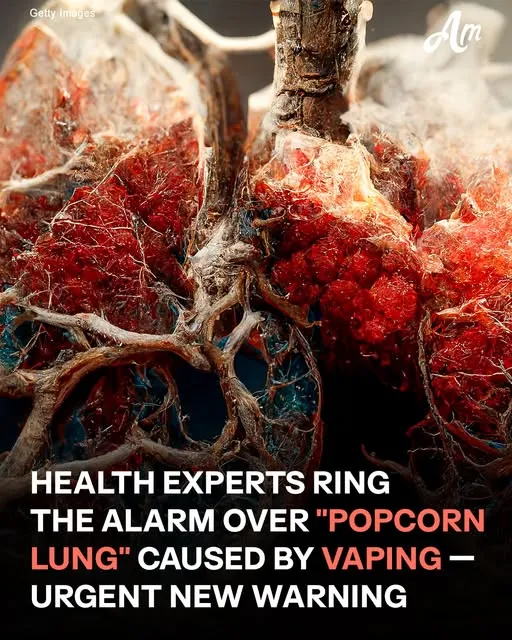 Experts Ring the Alarm Over 'Popcorn Lung' Caused by Vaping — Details