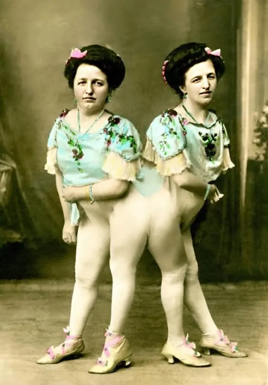 One of the Siamese Twins Got Pregnant and Gave Birth to a Son: This Is What Their Baby Looks Like