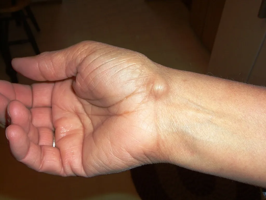 5. This Lump may Appear Due to Something you do Every day