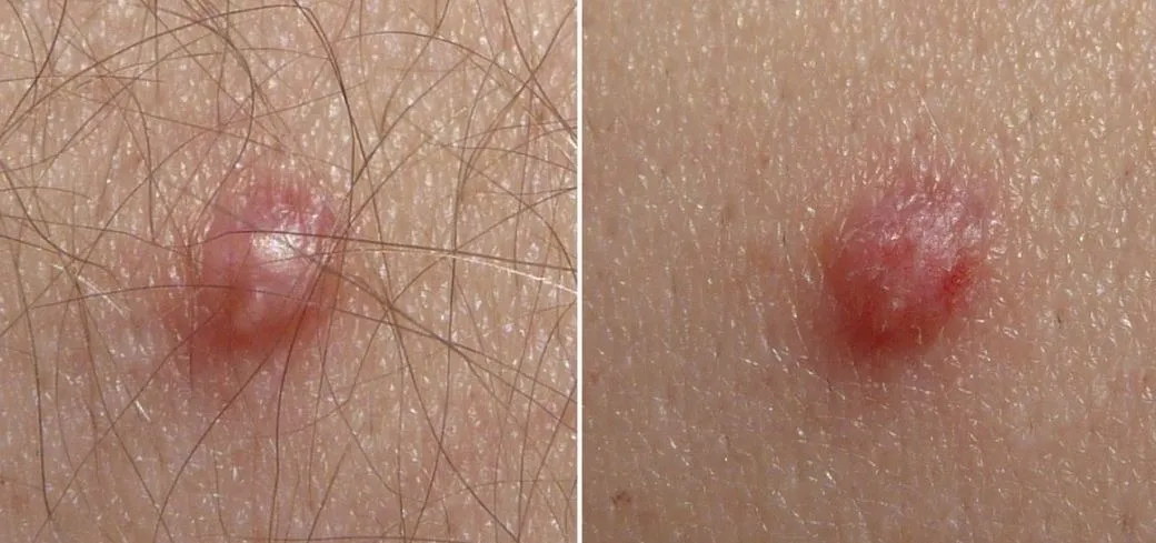 5.. Signs of Human Papillomavirus You Should Know-st