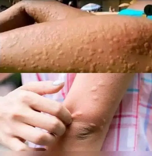 His Whole Body Was Itchy, and He Thought It Was an Allergy…