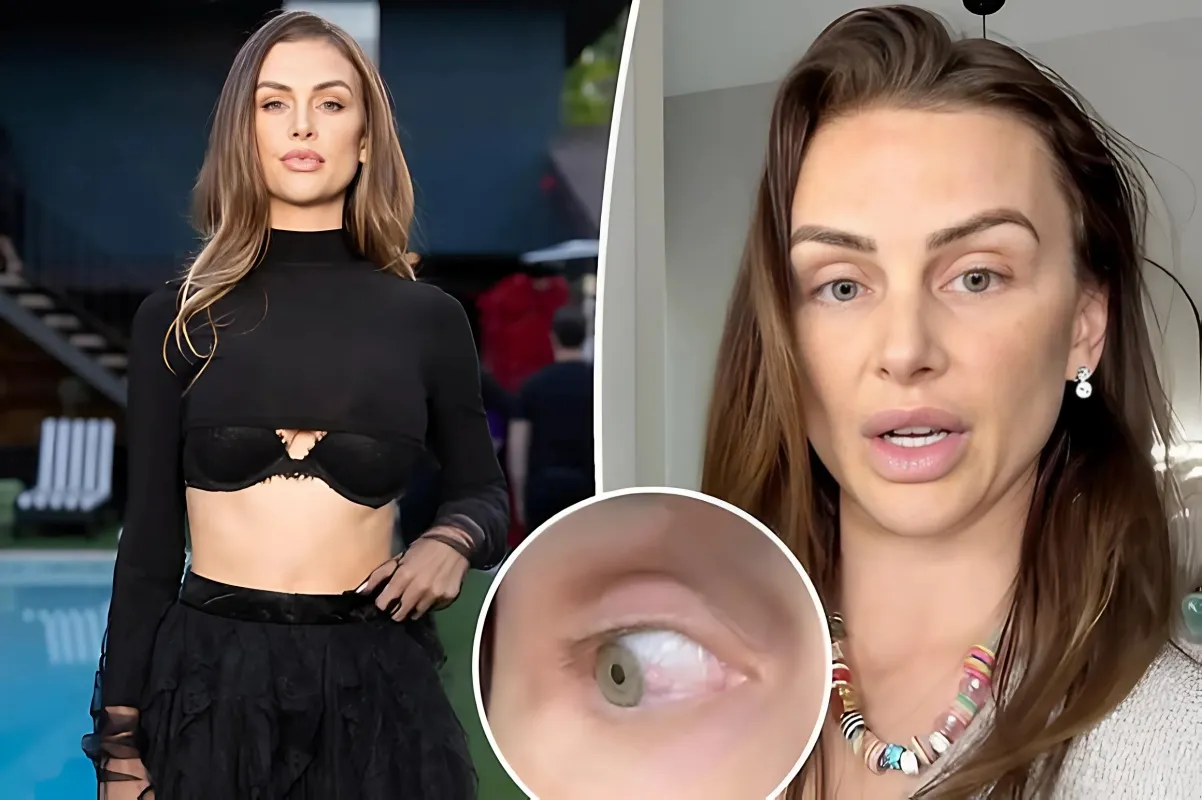 Lala Kent reveals she has a ‘terrifying’ pre-cancerous eye abnormality - lulu