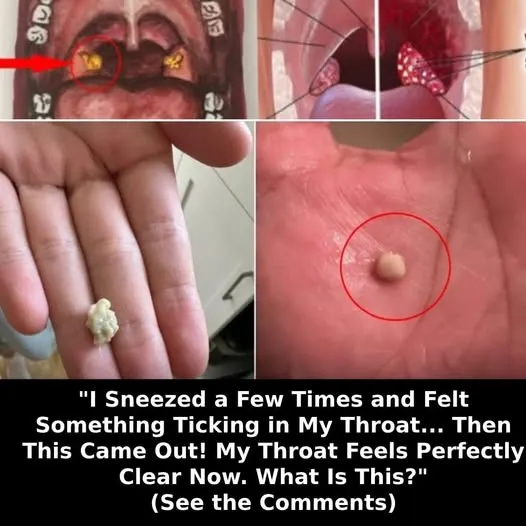 Here’s What You Need to Know About Tonsil Stones