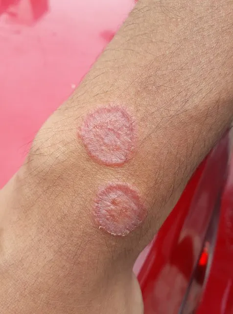 Skin diseases: ringworm