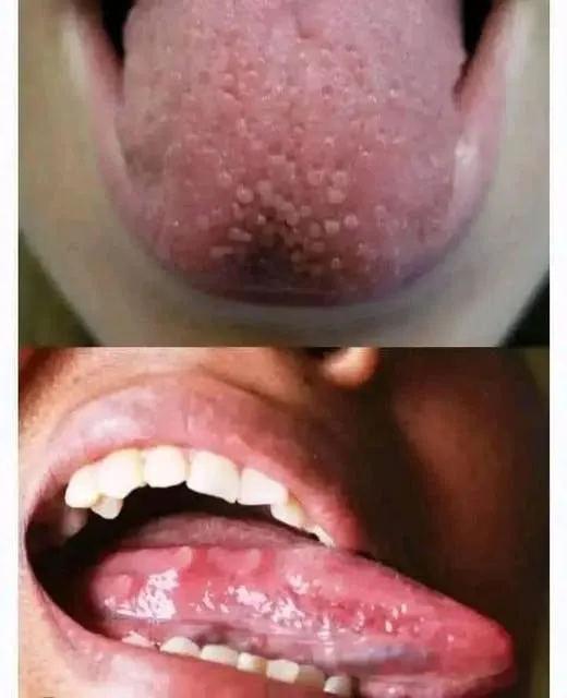 If you have pimples on your tongue, your body is warning you about something very important.