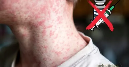 Tragedy in Texas: Child dies of measles