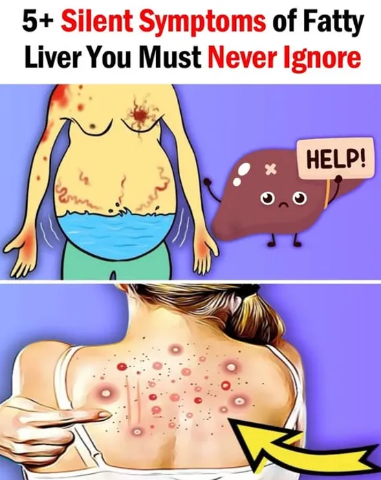 5 Silent Symptoms of Fatty Liver You Must Never Ignore 