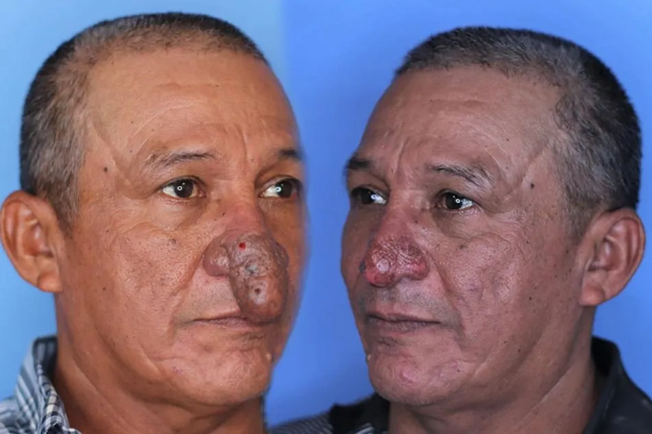 16.. The Remarkable Transformation of Conrado’s Nose
