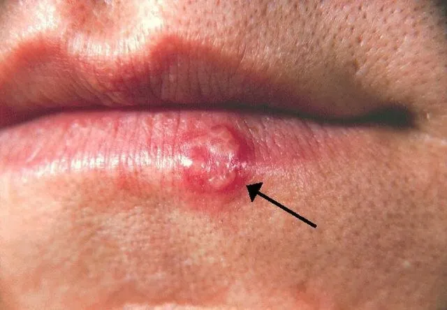 16. Most People Have Had or Have This Cold Sore Virus, But Very Few Know How to Cure It – Here’s What You Need to Do!