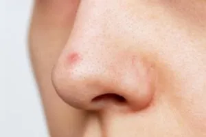 S1.  Why You Keep Getting Pimples Inside Your Nose, and What to Do About It