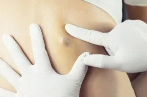 S3.  Understanding Skin Cysts: Causes, Treatments, and Medical Advice from Dermatologists