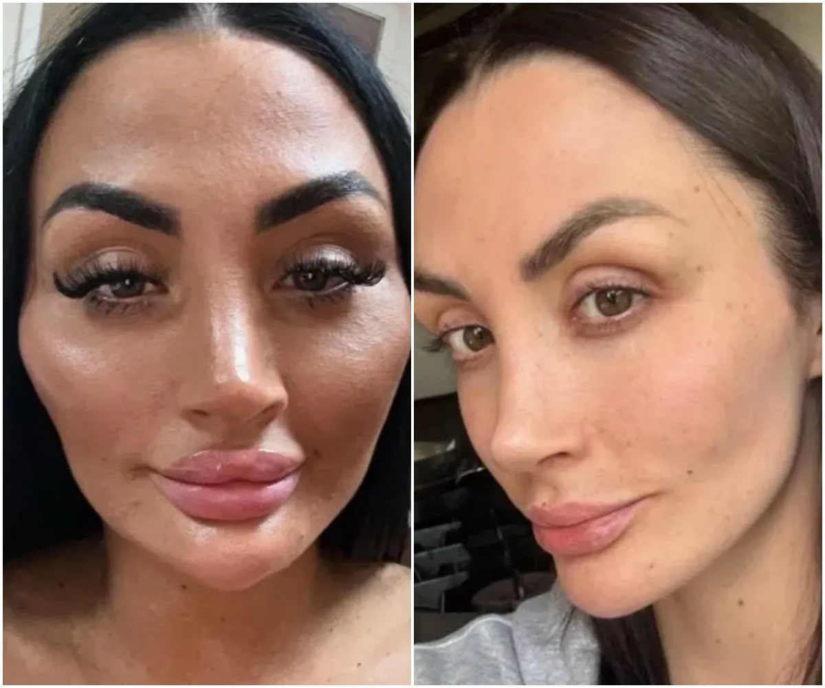 Love Island star unrecognisable after dissolving her lip, cheek and chin filler as she shows off VERY dramatic snaps - suong