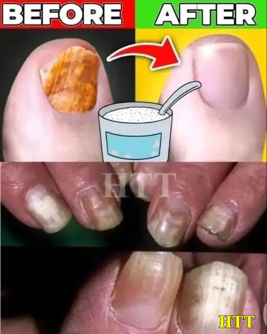Say Goodbye Nail Fungus naturally with simple remedies. The Best Natural Anti-Fungal That Must Try…