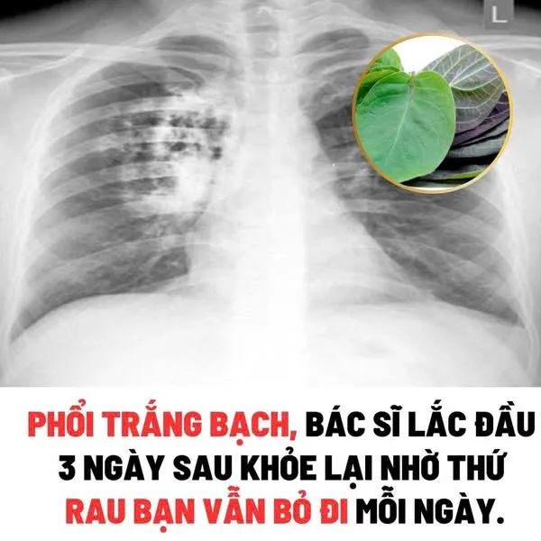 Sự Thật Gây Sốc Về Ung Thư Phổi Và Bài Thuốc Lá Mơ Lông + Nước Dừa. Hiệu Quả Sau 14 Ngày - Trà Giang