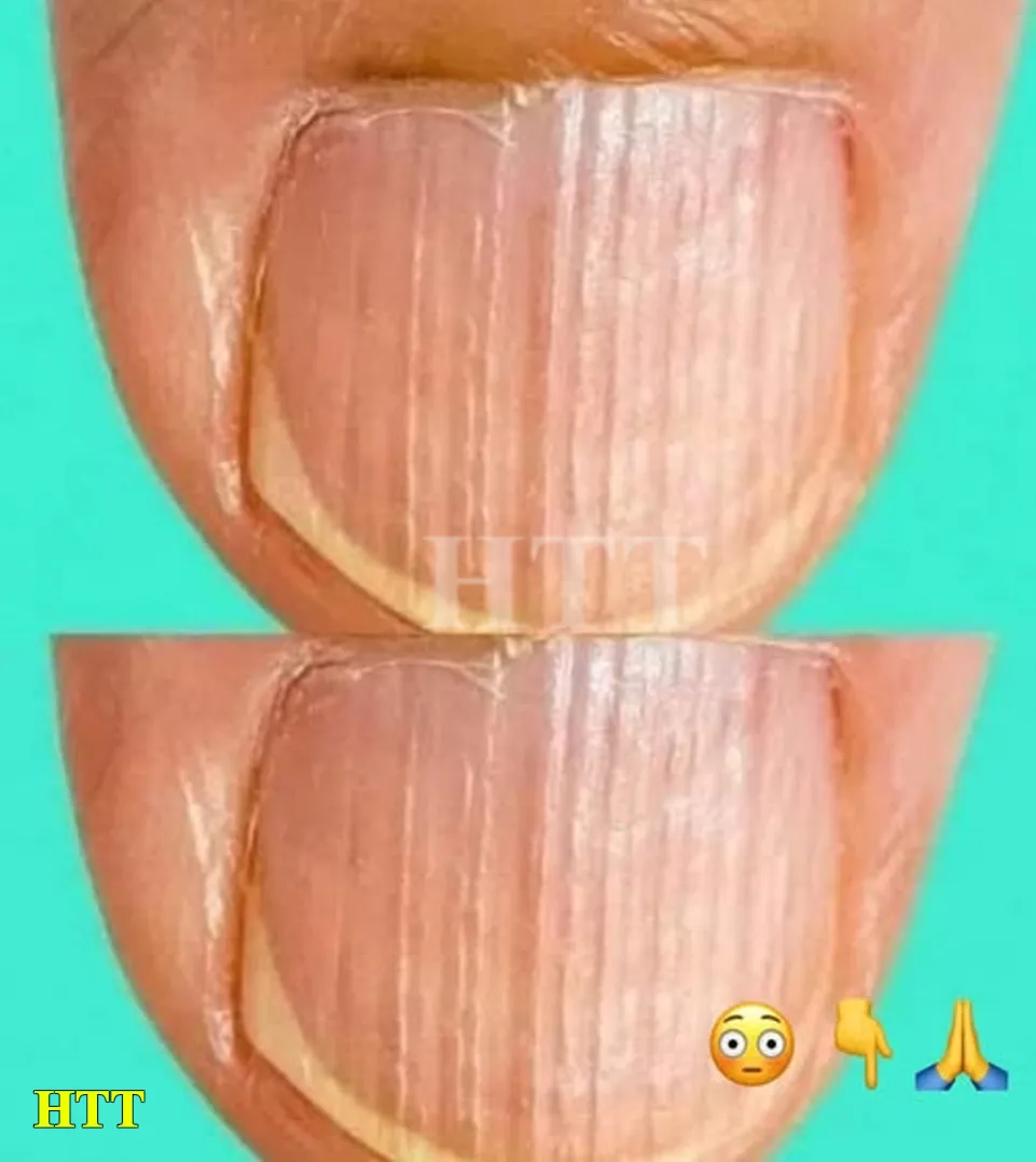 Doctor Reveals 7 Health Issues Hidden in Your Nails Doctor Reveals 7 Health Issues Hidden in Your Nails