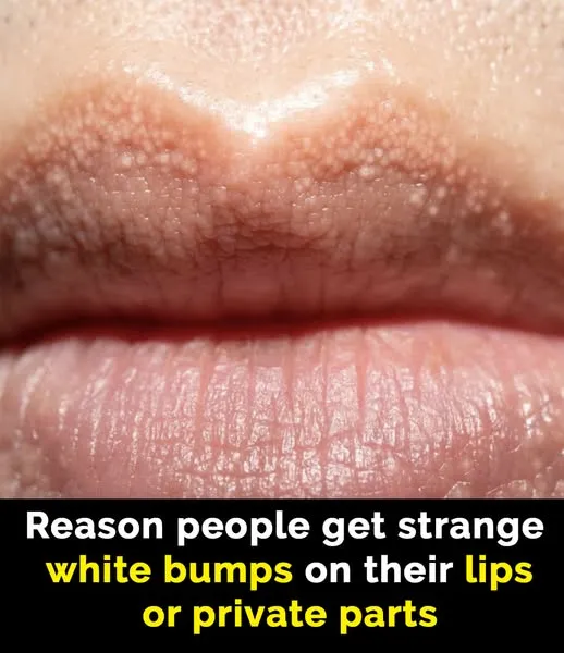 Reasons people get ‘white bumps’ on lips and other areas Reasons people get ‘white bumps’ on lips and other areas