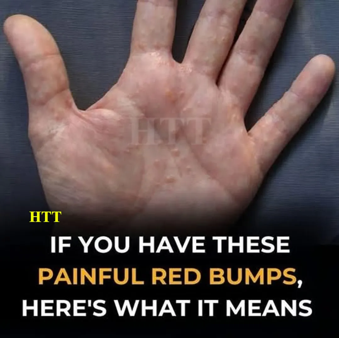 If You See These Painful Red Bumps, You May Have Dyshidrotic Eczema