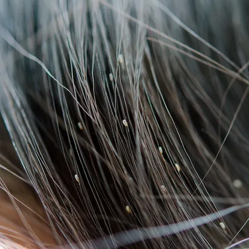 Head lice: How to get rid of them and stop them coming back