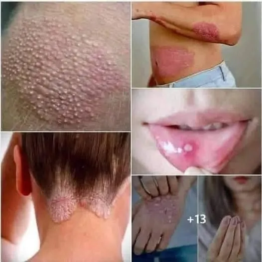 HT10. Signs of Human Papillomavirus You Should Know