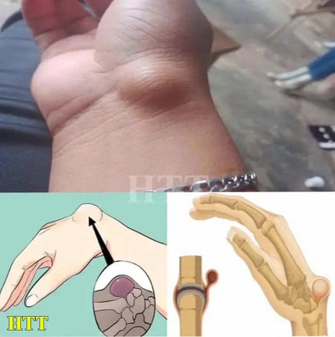 This Lump may Appear Due to Something you do Every day
