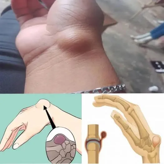 This Lump may Appear Due to Something you do Every day