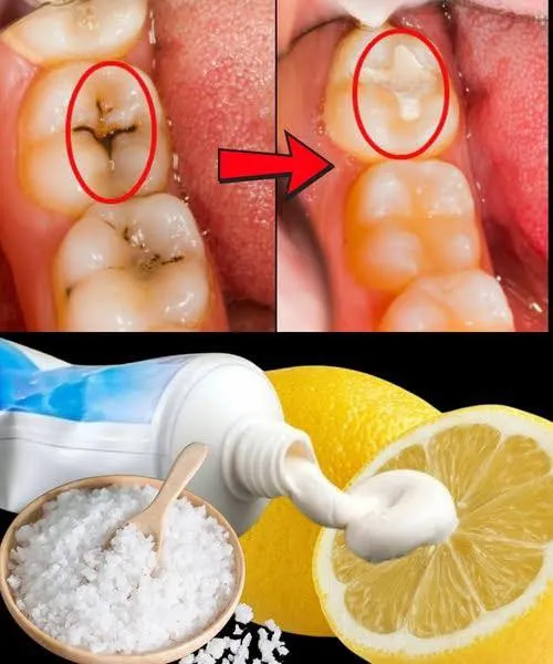 How to naturally repair a cavity. Keep these tips in mind to avoid visiting the dentist Must say something to keep getting my recipes 🙏 Full recipe in the first comment 💬👀